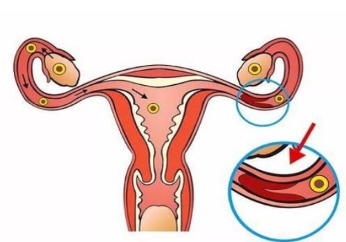 乳房下垂怎样恢复紧实,小方法告别下垂